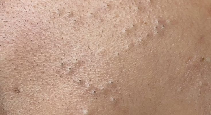 How to Treat and Prevent Deep Blackheads