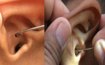 ear wax removal - how to remove ear wax