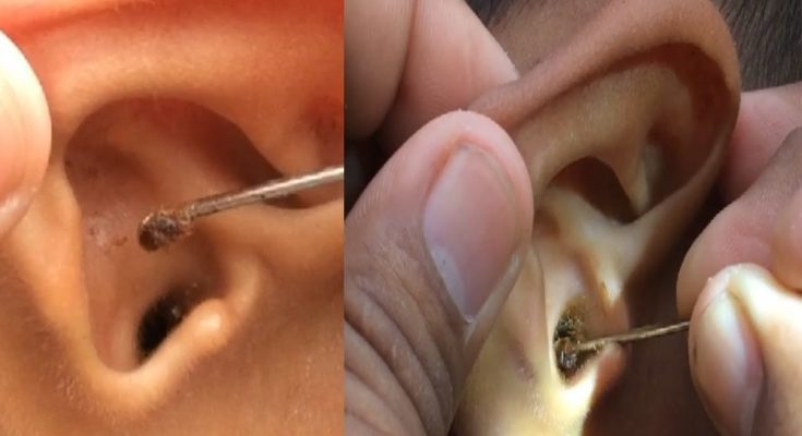 ear wax removal - how to remove ear wax