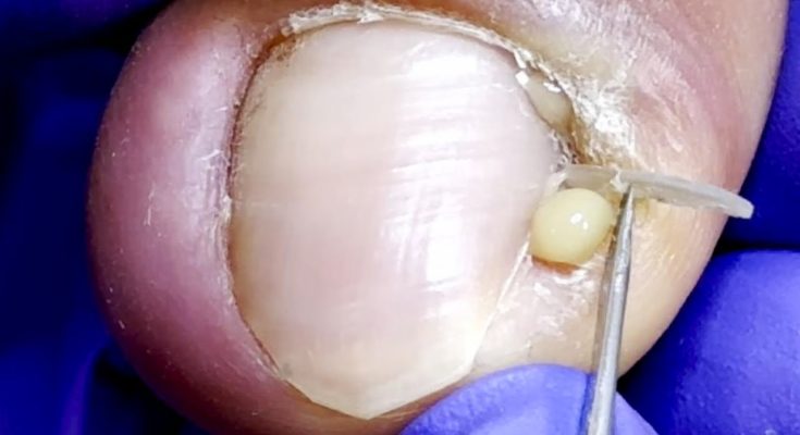 Lots Of Pus Coming Out! ! Nails Crazily Embedded【Doctor Liu Pedicure】