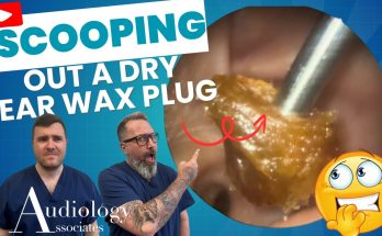 Epic Earwax Removal: Scooping Out a Huge Plug!