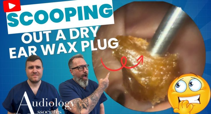 Epic Earwax Removal: Scooping Out a Huge Plug!