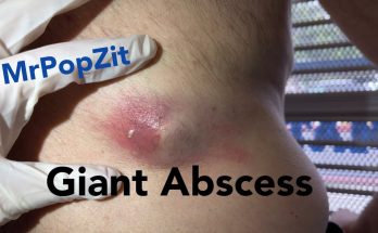 Drainage of an arm abscess