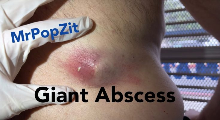 Drainage of an arm abscess