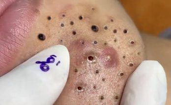 How do I get rid of blackheads safely?