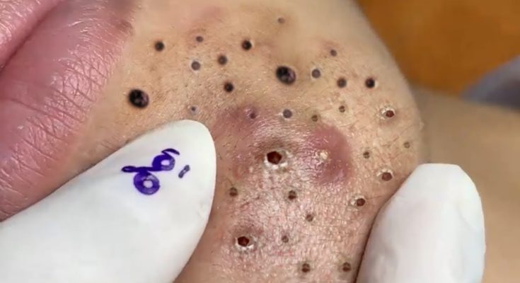 How do I get rid of blackheads safely?