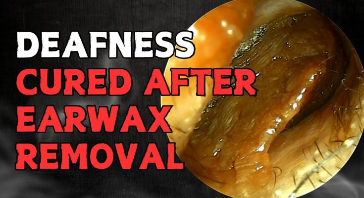 Deafness CURED After Earwax Removal