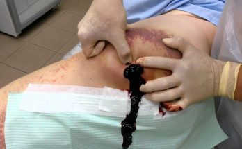 Opening of bursal hematoma