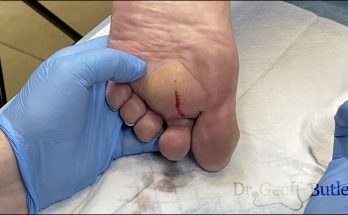 Unexpected drainage of an abscess on the foot