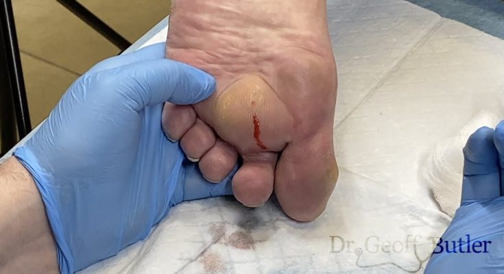 Unexpected drainage of an abscess on the foot