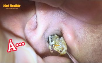 asmr- Earwax cleaning