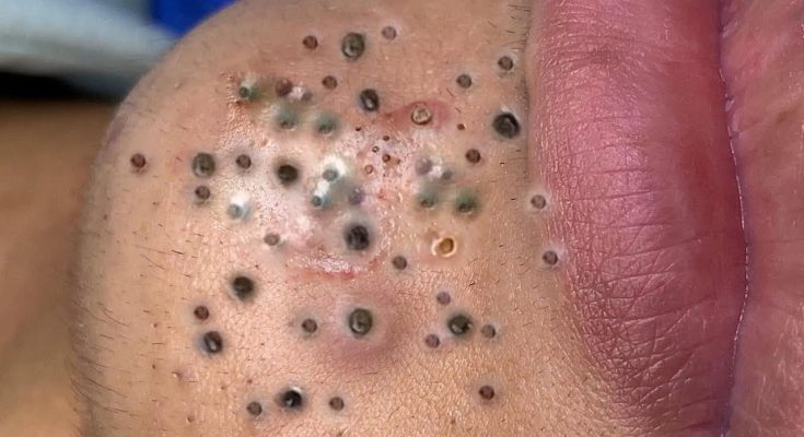 Blackheads Relax Every Day with usa sky News