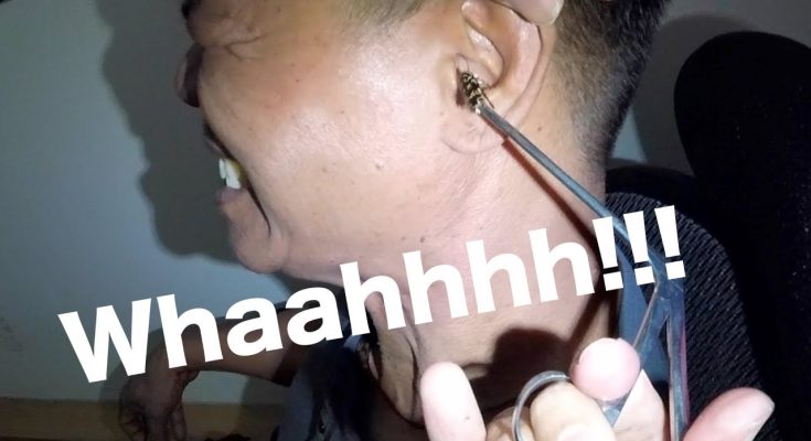 Something Big Got Stuck in Man's Ear- Guess What?