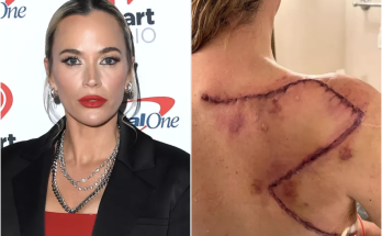 Teddi Mellencamp Reshares Graphic Image of Surgery Scar for World Cancer Day: 'Get Your Skin Checks Scheduled'