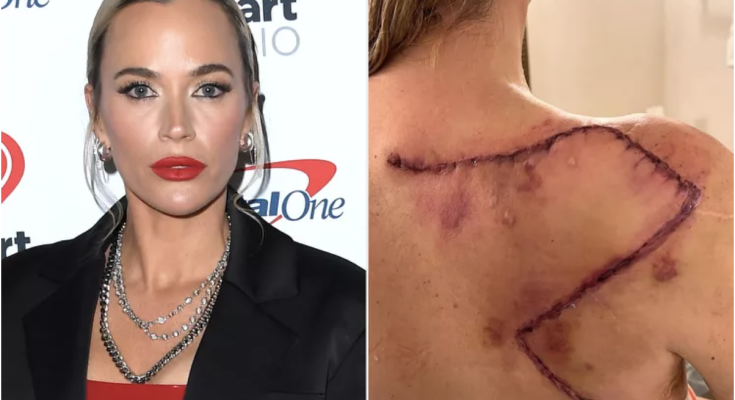 Teddi Mellencamp Reshares Graphic Image of Surgery Scar for World Cancer Day: 'Get Your Skin Checks Scheduled'