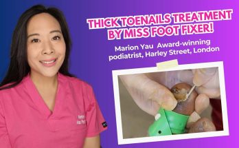 (video inside ) Thick toenails treatment by Miss Foot Fixer!