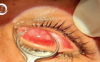 Chalazion surgery