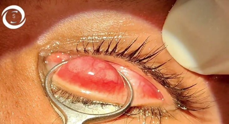 Chalazion surgery