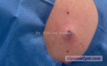 Blackhead extraction . Dr Khaled Sadek