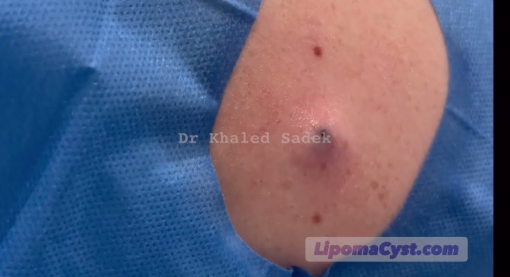 Blackhead extraction . Dr Khaled Sadek