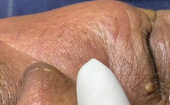 Blackheads Removal at CA ROT