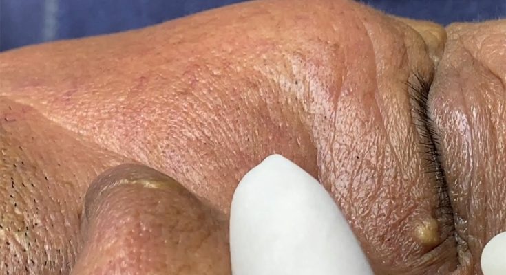 Blackheads Removal at CA ROT