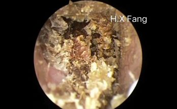 Difficult earwax removal, really not easy