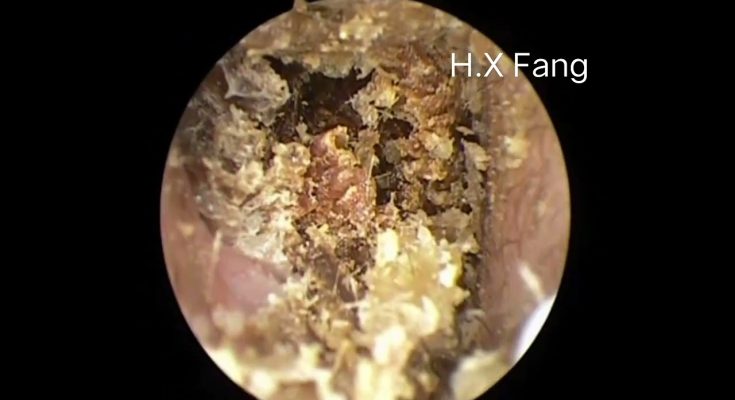 Difficult earwax removal, really not easy