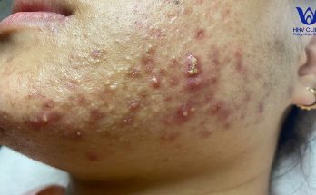 (video inside) Squeezing acne, hidden acne - Guaranteed effectiveness after 1 treatment. p2