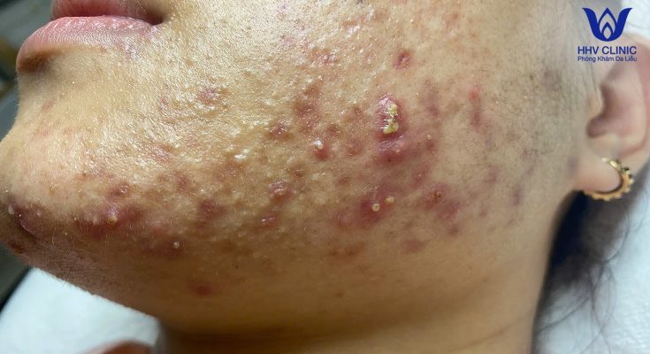 (video inside) Squeezing acne, hidden acne - Guaranteed effectiveness after 1 treatment. p2