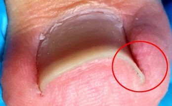 Super obvious ingrown toenail, completely repaired【Crazy pedicure room】