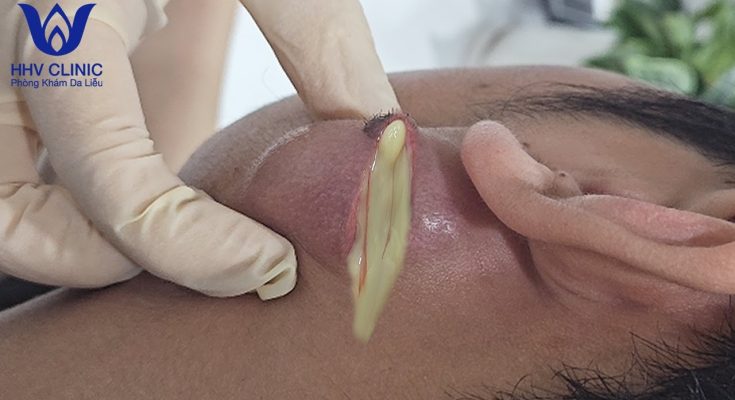 Cystic acne treatment at HHV Clinic