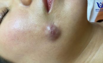 ( video inside ) Squeezing abscesses on the cheek - Guaranteed results after 1 session.