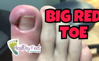 Big Red Toe From Ingrown Nail!