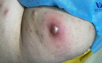 Squeezing abscesses in the buttocks area - Guaranteed effectiveness after 1 treatment - Acne does not recur.