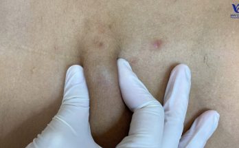 Squeezing sebaceous cysts on the chest - At HHV Clinic Dermatology Clinic