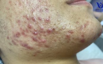 (video inside) Squeezing acne, hidden acne - Guaranteed effectiveness after 1 treatment.