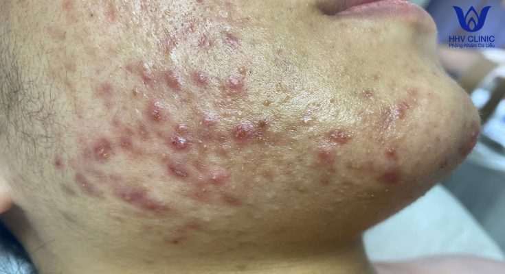 (video inside) Squeezing acne, hidden acne - Guaranteed effectiveness after 1 treatment.