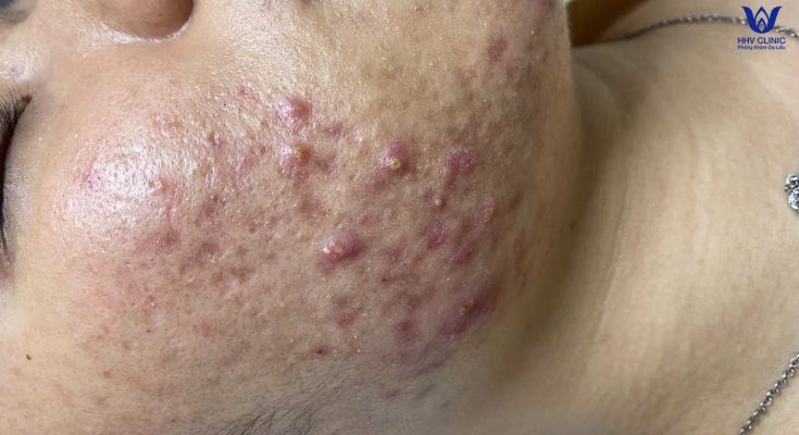 Squeezing inflammatory acne - cystic acne at HHV Clinic