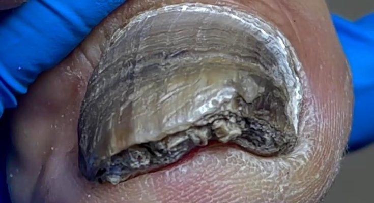 Super dirty nails, filled with germs